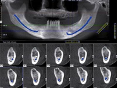 3D-Aufnahme zur Implantatplanung